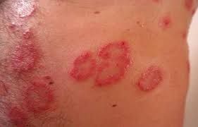 Skin Diseases