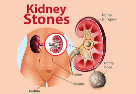 Kidney Stones